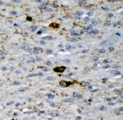 IHC staining of FFPE human glioma with GAD2 antibody. HIER: boil tissue sections in pH8 EDTA for 20 min and allow to cool before testing.