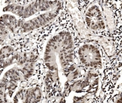 IHC staining of FFPE human rectal cancer with HNRNPD antibody. HIER: boil tissue sections in pH8 EDTA for 20 min and allow to cool before testing.