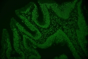 Immunofluorescent staining of FFPE human rectal cancer with hnRNP D antibody. HIER: boil tissue sections in pH8 EDTA for 20 min and allow to cool before testing.