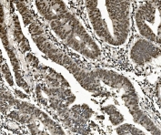 IHC staining of FFPE human rectal cancer with hnRNP D antibody. HIER: boil tissue sections in pH8 EDTA for 20 min and allow to cool before testing.