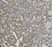 IHC staining of FFPE human liver cancer with CYP2C19 antibody. HIER: boil tissue sections in pH8 EDTA for 20 min and allow to cool before testing.