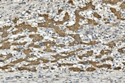 IHC staining of FFPE human liver cancer with CYP2C19 antibody. HIER: boil tissue sections in pH8 EDTA for 20 min and allow to cool before testing.