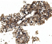 IHC staining of FFPE human renal cancer with ACO1 antibody. HIER: boil tissue sections in pH8 EDTA for 20 min and allow to cool before testing.