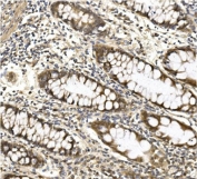 IHC staining of FFPE human rectal cancer with ACO1 antibody. HIER: boil tissue sections in pH8 EDTA for 20 min and allow to cool before testing.