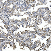 IHC staining of FFPE human lung cancer with CALCOCO2 antibody. HIER: boil tissue sections in pH8 EDTA for 20 min and allow to cool before testing.