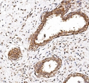 IHC staining of FFPE human breast cancer with CALCOCO2 antibody. HIER: boil tissue sections in pH8 EDTA for 20 min and allow to cool before testing.