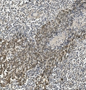 IHC staining of FFPE human lung cancer with HP1 alpha antibody. HIER: boil tissue sections in pH8 EDTA for 20 min and allow to cool before testing.