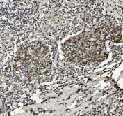 IHC staining of FFPE human lung cancer with HP1 alpha antibody. HIER: boil tissue sections in pH8 EDTA for 20 min and allow to cool before testing.