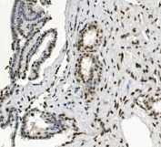 IHC staining of FFPE human breast cancer with HP1 alpha antibody. HIER: boil tissue sections in pH8 EDTA for 20 min and allow to cool before testing.