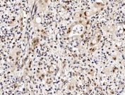 IHC staining of FFPE human rectal cancer with CBX8 antibody. HIER: boil tissue sections in pH8 EDTA for 20 min and allow to cool before testing.