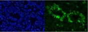 Immunofluorescent staining of FFPE human rectal cancer with CBX8 antibody. HIER: boil tissue sections in pH8 EDTA for 20 min and allow to cool before testing.