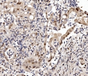 IHC staining of FFPE human rectal cancer with CBX8 antibody. HIER: boil tissue sections in pH8 EDTA for 20 min and allow to cool before testing.