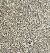 IHC staining of FFPE human B-lymphocyte tumor with CD69 antibody. HIER: boil tissue sections in pH8 EDTA for 20 min and allow to cool before testing.