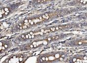 IHC staining of FFPE human rectal cancer with CLPB antibody. HIER: boil tissue sections in pH8 EDTA for 20 min and allow to cool before testing.