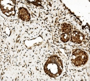 IHC staining of FFPE human breast cancer with CLPB antibody. HIER: boil tissue sections in pH8 EDTA for 20 min and allow to cool before testing.