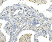 IHC staining of FFPE human lung cancer with Endothelin A Receptor antibody. HIER: boil tissue sections in pH8 EDTA for 20 min and allow to cool before testing.