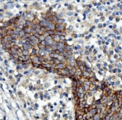 IHC staining of FFPE human lung cancer with EGF Receptor antibody. HIER: boil tissue sections in pH8 EDTA for 20 min and allow to cool before testing.