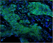Immunofluorescent staining of FFPE human lung cancer with EGF Receptor antibody (green) and DAPI (blue). HIER: boil tissue sections in pH8 EDTA for 20 min and allow to cool before testing.