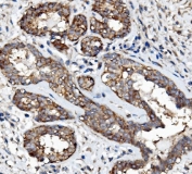 IHC staining of FFPE human breast cancer with EGF Receptor antibody. HIER: boil tissue sections in pH8 EDTA for 20 min and allow to cool before testing.