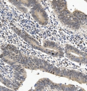 IHC staining of FFPE human rectal cancer with EYA4 antibody. HIER: boil tissue sections in pH8 EDTA for 20 min and allow to cool before testing.