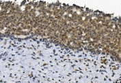 IHC staining of FFPE human breast cancer with EYA4 antibody. HIER: boil tissue sections in pH8 EDTA for 20 min and allow to cool before testing.