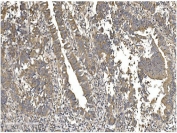 IHC staining of FFPE human rectal cancer with Gasdermin D antibody. HIER: boil tissue sections in pH8 EDTA for 20 min and allow to cool before testing.