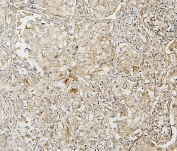 IHC staining of FFPE human lung cancer with IRF3 antibody. HIER: boil tissue sections in pH8 EDTA for 20 min and allow to cool before testing.