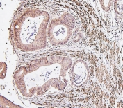 IHC staining of FFPE human rectal cancer with IRF3 antibody. HIER: boil tissue sections in pH8 EDTA for 20 min and allow to cool before testing.
