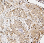 IHC staining of FFPE human breast cancer with IRF3 antibody. HIER: boil tissue sections in pH8 EDTA for 20 min and allow to cool before testing.