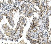 IHC staining of FFPE human lung cancer with ITGB4 antibody. HIER: boil tissue sections in pH8 EDTA for 20 min and allow to cool before testing.