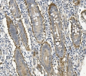 IHC staining of FFPE human rectal cancer with ITGB4 antibody. HIER: boil tissue sections in pH8 EDTA for 20 min and allow to cool before testing.