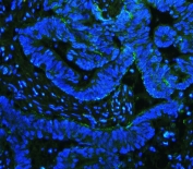 Immunofluorescent staining of FFPE human intestinal cancer with ITGB4 antibody (green) and DAPI (blue). HIER: boil tissue sections in pH8 EDTA for 20 min and allow to cool before testing.