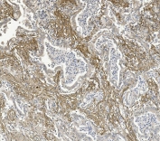 IHC staining of FFPE human rectal cancer with ITGB5 antibody. HIER: boil tissue sections in pH8 EDTA for 20 min and allow to cool before testing.