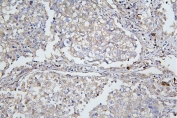 IHC staining of FFPE human lung cancer with ApoER2 antibody. HIER: boil tissue sections in pH8 EDTA for 20 min and allow to cool before testing.