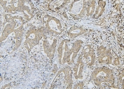 IHC staining of FFPE human rectal cancer with ApoER2 antibody. HIER: boil tissue sections in pH8 EDTA for 20 min and allow to cool before testing.