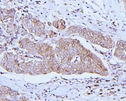 IHC staining of FFPE human breast cancer with ApoER2 antibody. HIER: boil tissue sections in pH8 EDTA for 20 min and allow to cool before testing.