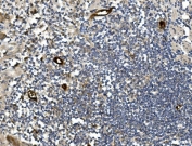 IHC staining of FFPE human rectal cancer with MADCAM1 antibody. HIER: boil tissue sections in pH8 EDTA for 20 min and allow to cool before testing.