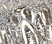 IHC staining of FFPE human rectal cancer with MADCAM1 antibody. HIER: boil tissue sections in pH8 EDTA for 20 min and allow to cool before testing.