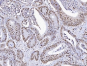IHC staining of FFPE human intestinal cancer with MCM6 antibody. HIER: boil tissue sections in pH8 EDTA for 20 min and allow to cool before testing.