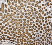 IHC staining of FFPE human rectal cancer with Mucin 2 antibody. HIER: boil tissue sections in pH8 EDTA for 20 min and allow to cool before testing.