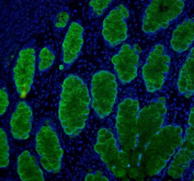 Immunofluorescent staining of FFPE human intestinal cancer with Mucin 2 antibody (green) and DAPI (blue). HIER: boil tissue sections in pH8 EDTA for 20 min and allow to cool before testing.