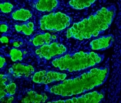 Immunofluorescent staining of FFPE human intestinal cancer with Mucin 2 antibody (green) and DAPI (blue). HIER: boil tissue sections in pH8 EDTA for 20 min and allow to cool before testing.