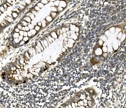 IHC staining of FFPE human rectal cancer with Nectin 1 antibody. HIER: boil tissue sections in pH8 EDTA for 20 min and allow to cool before testing.