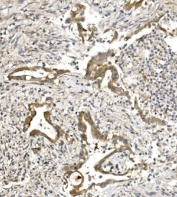 IHC staining of FFPE human rectal cancer with Nectin 1 antibody. HIER: boil tissue sections in pH8 EDTA for 20 min and allow to cool before testing.
