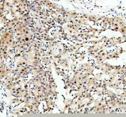 IHC staining of FFPE human bladder cancer tissue with NFAT5 antibody. HIER: boil tissue sections in pH8 EDTA for 20 min and allow to cool before testing.