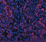 Immunofluorescent staining of FFPE human bladder cancer tissue with NFAT5 antibody (red) and DAPI nuclear stain (blue). HIER: steam section in pH8 EDTA buffer for 20 min.