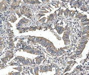 IHC staining of FFPE human rectal cancer with PDE6 alpha antibody. HIER: boil tissue sections in pH8 EDTA for 20 min and allow to cool before testing.