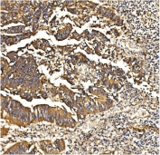 IHC staining of FFPE human rectal cancer with PDE6 beta antibody. HIER: boil tissue sections in pH8 EDTA for 20 min and allow to cool before testing.