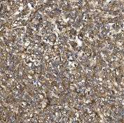 IHC staining of FFPE human liver cancer with PDE6 beta antibody. HIER: boil tissue sections in pH8 EDTA for 20 min and allow to cool before testing.