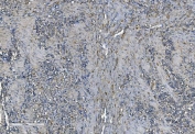 IHC staining of FFPE human gastric cancer with PNPT1 antibody. HIER: boil tissue sections in pH8 EDTA for 20 min and allow to cool before testing.
